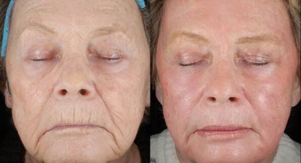 before and after laser renewal